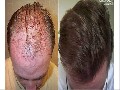 The Forhair Clinic : Hair Surgery in Atlanta, GA