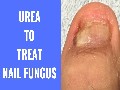 Use Urea to Kill Your Nail Fungus