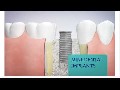 Arlington Dental Associates - Mini Dental Implants in Arling