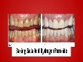 3 proven teeth stain home remedies