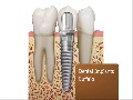 Southtowns Dental Implants in Buffalo, NY
