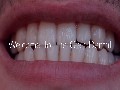 /cb7c38a1e4-the-glen-dental-teeth-implants-in-san-jose