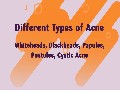 /797c3b999d-different-types-of-acne-and-treatments