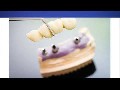 Salvatore Dental Implants in Ballston Spa, NY | 518-254-6062