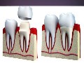 Best Root Canal At Florida Dental Care of Miller