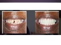 Fort Lauderdale Dentist | Dr. Robert | Stanton Smiles