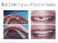 /efd2e2777c-best-dental-implants-in-palmdale-661-722-7722