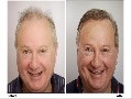 The Forhair Clinic : Hair Restoration Surgery