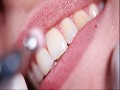 Miami Dental Group - Best Teeth Whitening in Kendall (305-27