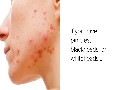 /26743e1223-fast-working-home-remedies-for-acne