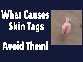 /462e5cdd85-know-the-reason-for-skin-tags-and-avoid-them