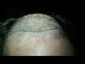 /f40a7c4a0f-baldness-treatment-india