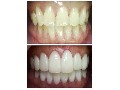 /8e141f3a24-best-dental-crowns-at-florida-dental-care-of-miller