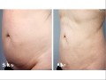 Los Angeles Liposuction Centers - Plastic Surgeon