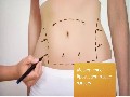 /12085467f9-best-liposuction-cost-in-los-angeles-ca-310-271-5875