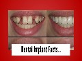 /ec86ebfb7d-dental-implant-facts
