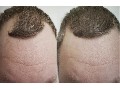/da141891c8-best-laser-hair-growth-device-844-454-4377