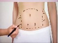 /d5f5028742-liposuction-in-beverly-hills-ca-310-271-5875