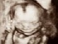 The Smiling Fetus