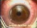 /5c94244f06-lasik-eye-surgery